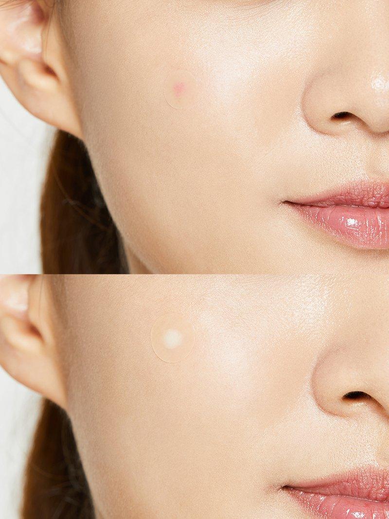 Acne & Blemishes
